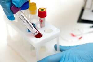 A medical worker holds a test tube with blood marked 'monkeypox.'